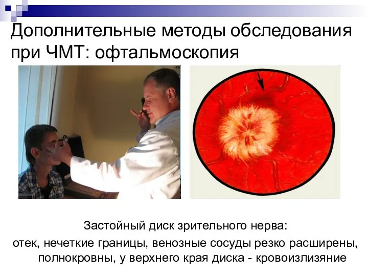 Дополнительные методы обследования при ЧМТ: офтальмоскопия Застойный диск зрительного нерва: отек,