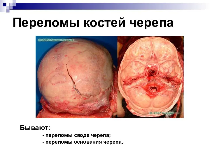 Переломы костей черепа Бывают: - переломы свода черепа; - переломы основания черепа.