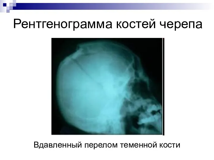 Рентгенограмма костей черепа Вдавленный перелом теменной кости