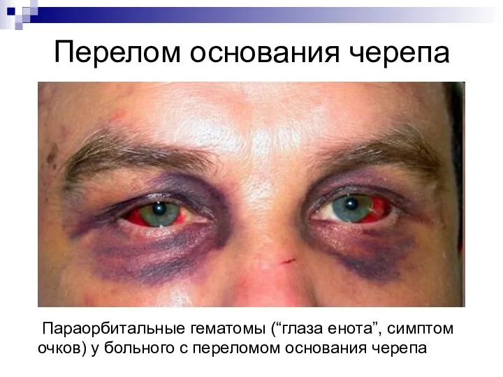 Перелом основания черепа Параорбитальные гематомы (“глаза енота”, симптом очков) у больного с переломом основания черепа