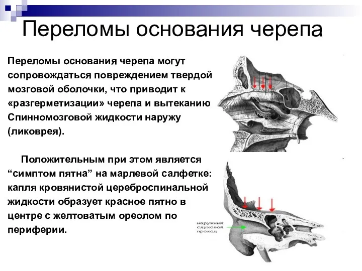 Переломы основания черепа Переломы основания черепа могут сопровождаться повреждением твердой мозговой