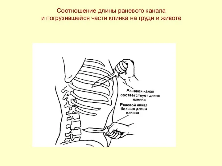 Соотношение длины раневого канала и погрузившейся части клинка на груди и животе