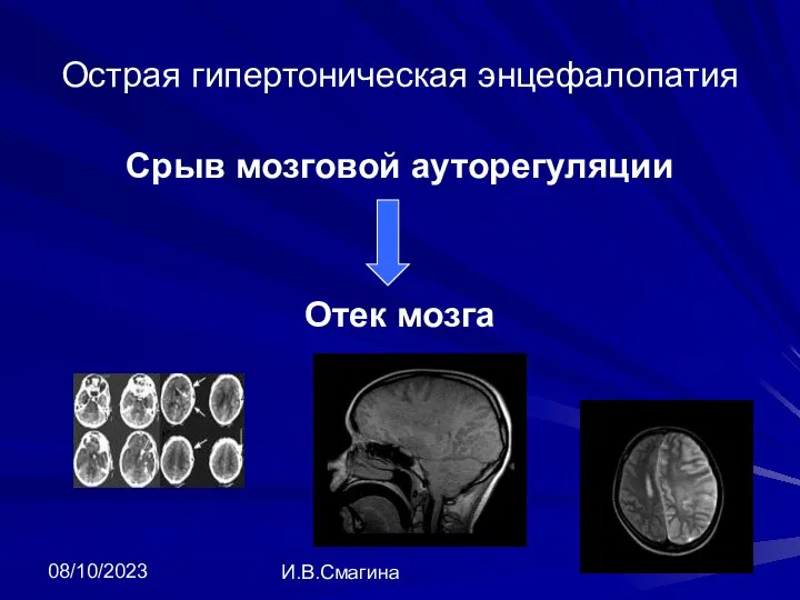 08/10/2023 И.В.Смагина Острая гипертоническая энцефалопатия Срыв мозговой ауторегуляции Отек мозга