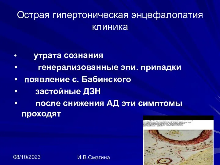 08/10/2023 И.В.Смагина Острая гипертоническая энцефалопатия клиника утрата сознания генерализованные эпи. припадки