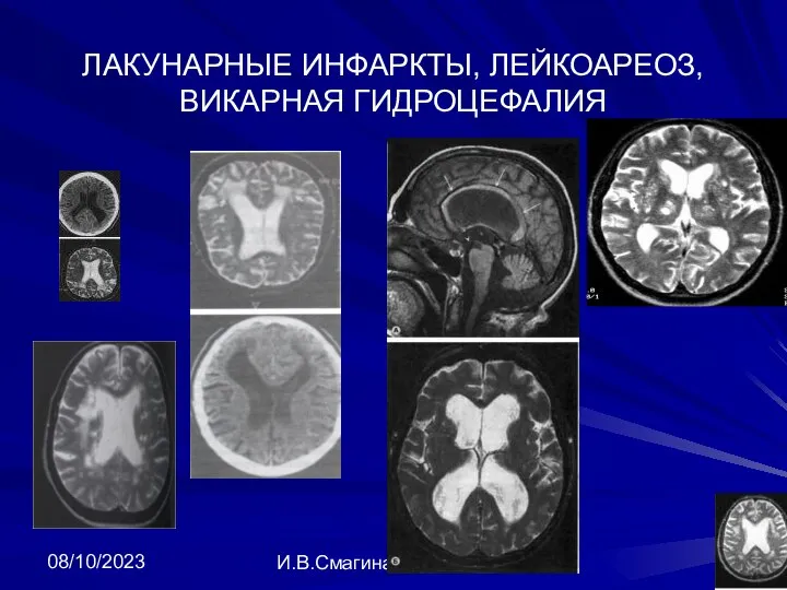 08/10/2023 И.В.Смагина ЛАКУНАРНЫЕ ИНФАРКТЫ, ЛЕЙКОАРЕОЗ, ВИКАРНАЯ ГИДРОЦЕФАЛИЯ