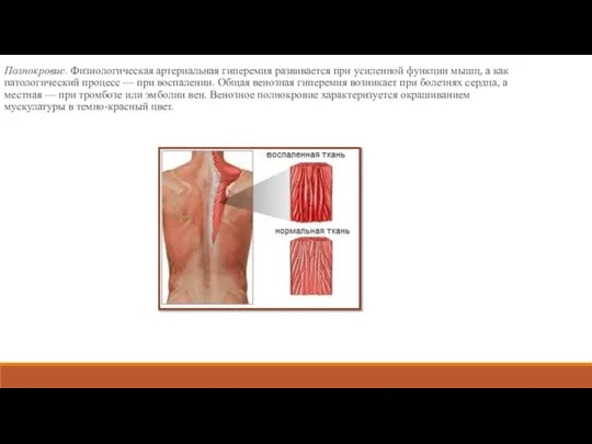 Полнокровие. Физиологическая артериальная гиперемия развивается при усиленной функции мышц, а как