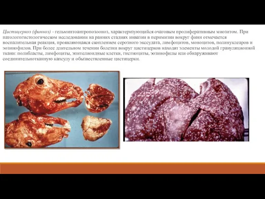 Цистицеркоз (финноз) - гельминтоантропозооноз, характеризующийся очаговым пролиферативным миозитом. При патологогистологическом исследовании