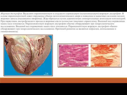 Жировая дистрофия. Выделяют паренхиматозную и сосудисто-стромальную (мезенхимальную) жировую дистрофию. В основе