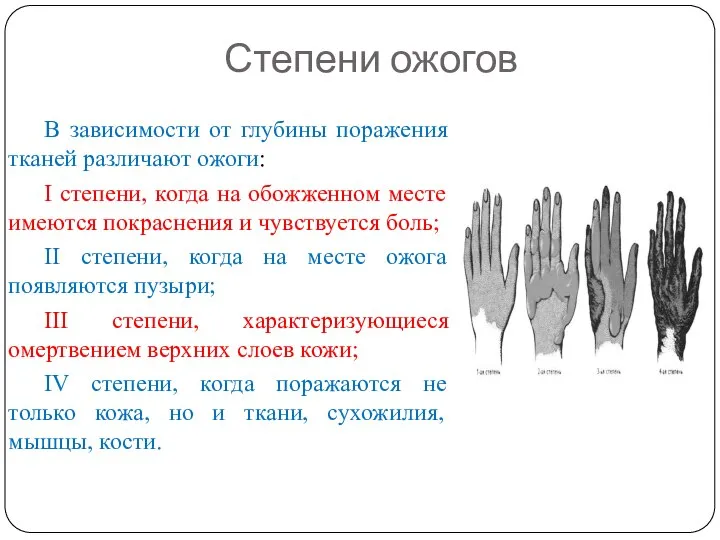 Степени ожогов В зависимости от глубины поражения тканей различают ожоги: I