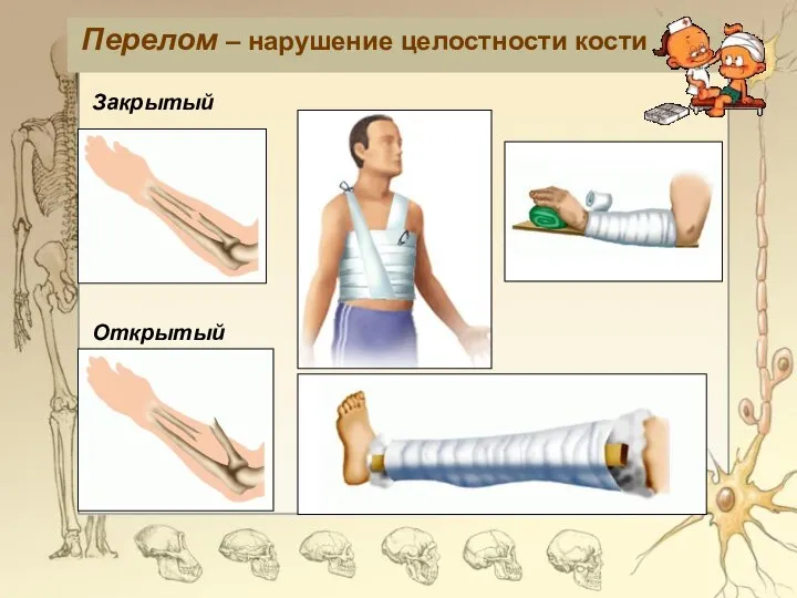 Перелом – нарушение целостности кости Закрытый Открытый