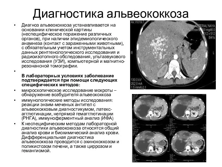 Диагностика альвеококкоза Диагноз альвеококкоза устанавливается на основании клинической картины (неспецифическое поражение