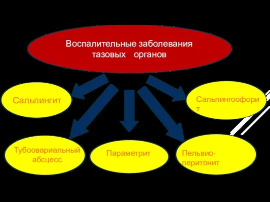 Воспалительные заболевания тазовых органов Сальпингит Параметрит Сальпингоофорит Тубоовариальный абсцесс Пельвио-перитонит