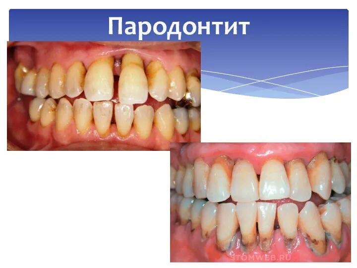 Пародонтит