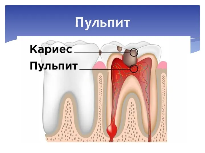 Пульпит