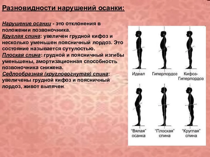 Разновидности нарушений осанки: Нарушение осанки - это отклонения в положении позвоночника.