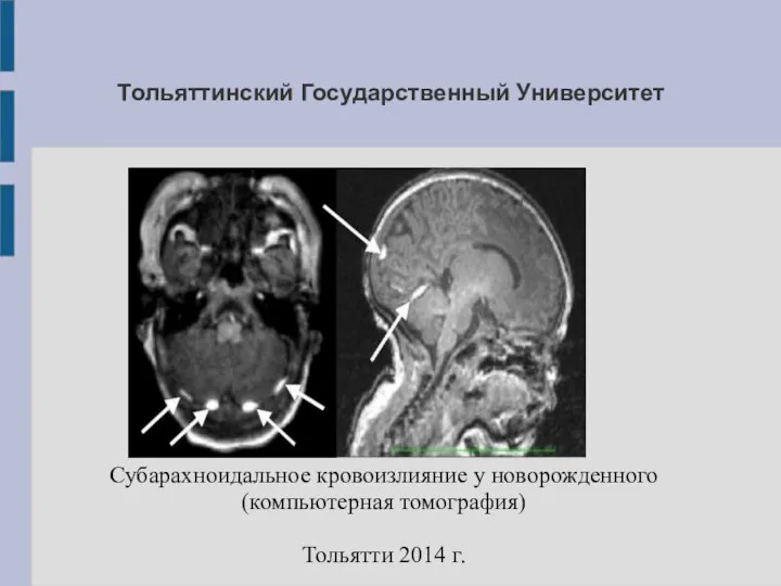 Тольяттинский Государственный Университет Субарахноидальное кровоизлияние у новорожденного(компьютерная томография) Тольятти 2014 г.