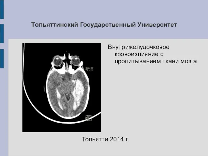 Тольяттинский Государственный Университет Внутрижелудочковое кровоизлияние с пропитыванием ткани мозга Тольятти 2014 г.