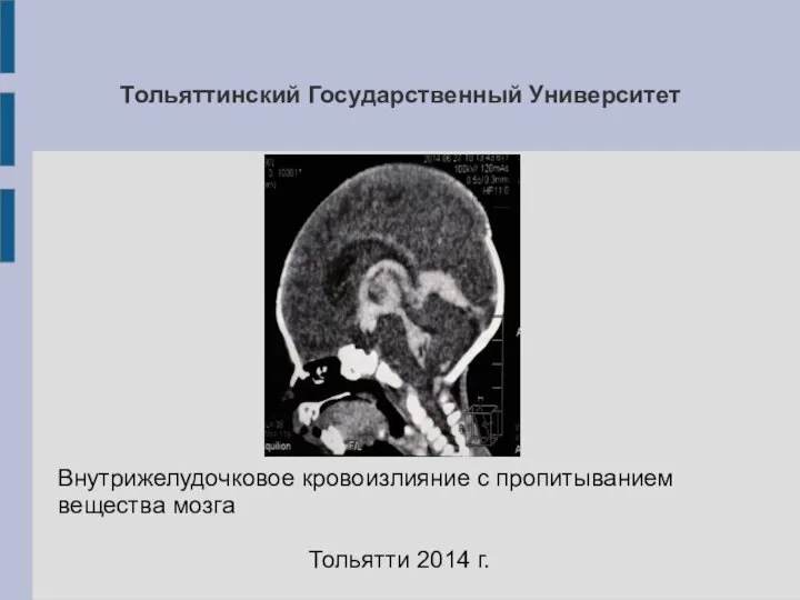 Тольяттинский Государственный Университет Внутрижелудочковое кровоизлияние с пропитыванием вещества мозга Тольятти 2014 г.