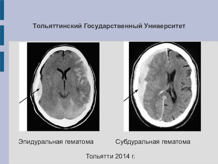 Тольяттинский Государственный Университет Эпидуральная гематома Субдуральная гематома Тольятти 2014 г.