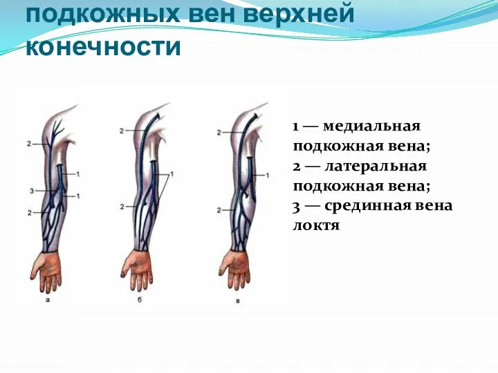 Варианты расположения подкожных вен верхней конечности 1 — медиальная подкожная вена;