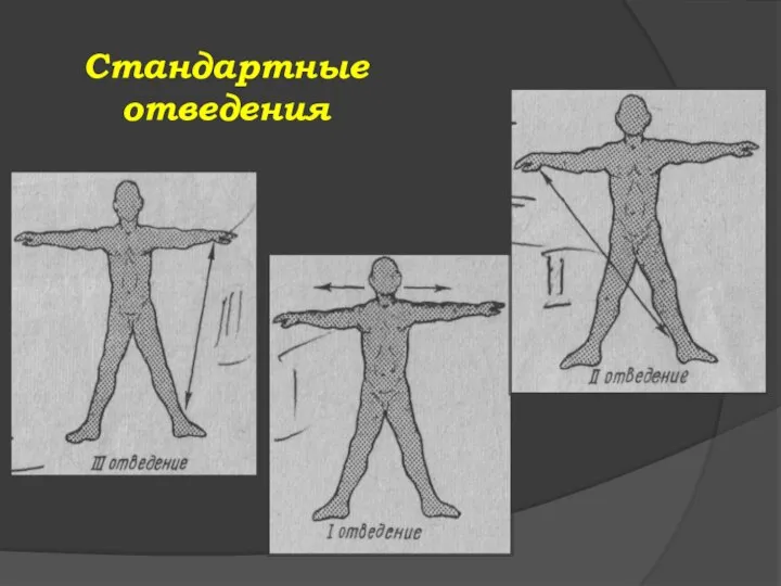 Стандартные отведения