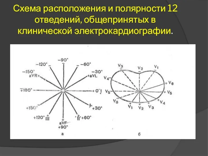 Схема расположения и полярности 12 отведений, общепринятых в клинической электрокардиографии.