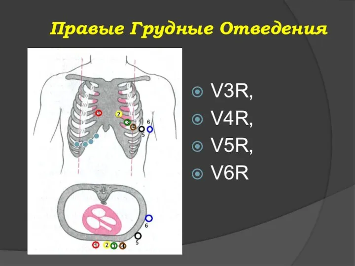 Правые Грудные Отведения V3R, V4R, V5R, V6R