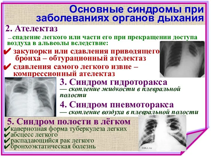 Основные синдромы при заболеваниях органов дыхания 2. Ателектаз — спадение легкого