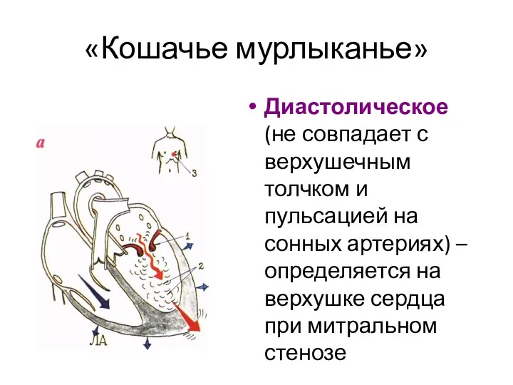 «Кошачье мурлыканье» Диастолическое (не совпадает с верхушечным толчком и пульсацией на