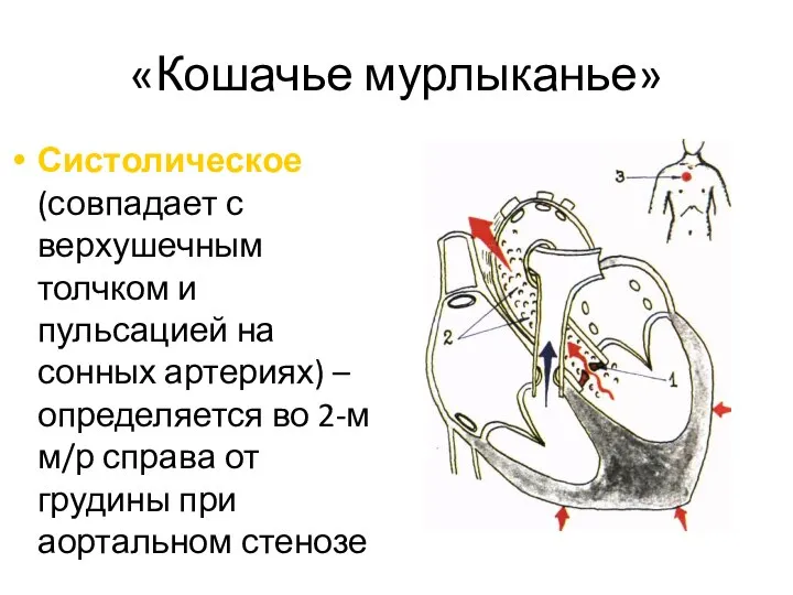 «Кошачье мурлыканье» Систолическое (совпадает с верхушечным толчком и пульсацией на сонных