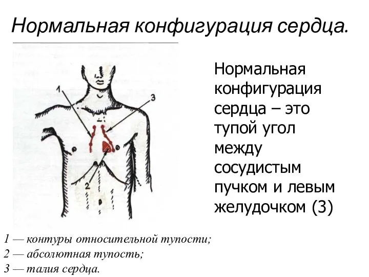 Нормальная конфигурация сердца. 1 — контуры относительной тупости; 2 — абсолютная