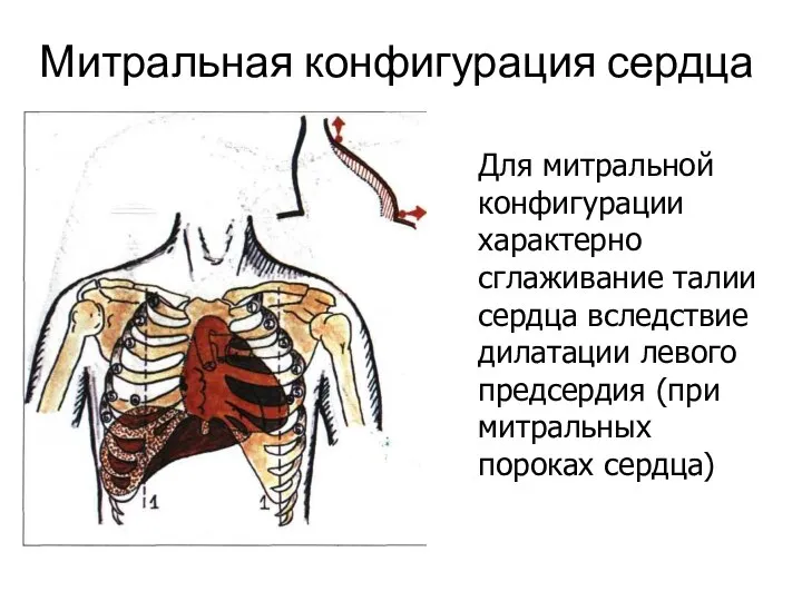 Митральная конфигурация сердца Для митральной конфигурации характерно сглаживание талии сердца вследствие