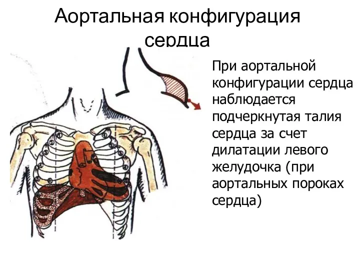 Аортальная конфигурация сердца При аортальной конфигурации сердца наблюдается подчеркнутая талия сердца
