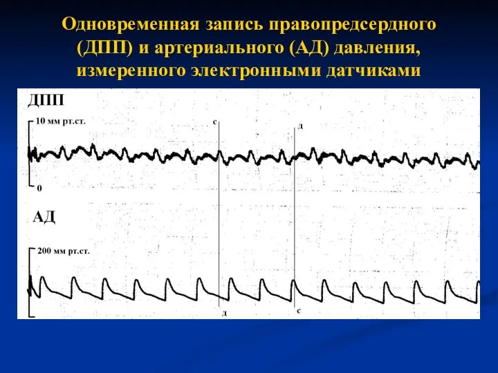 Одновременная запись правопредсердного (ДПП) и артериального (АД) давления, измеренного электронными датчиками