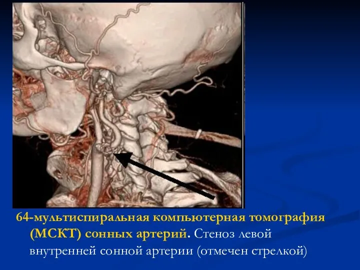 64-мультиспиральная компьютерная томография (МСКТ) сонных артерий. Стеноз левой внутренней сонной артерии (отмечен стрелкой)