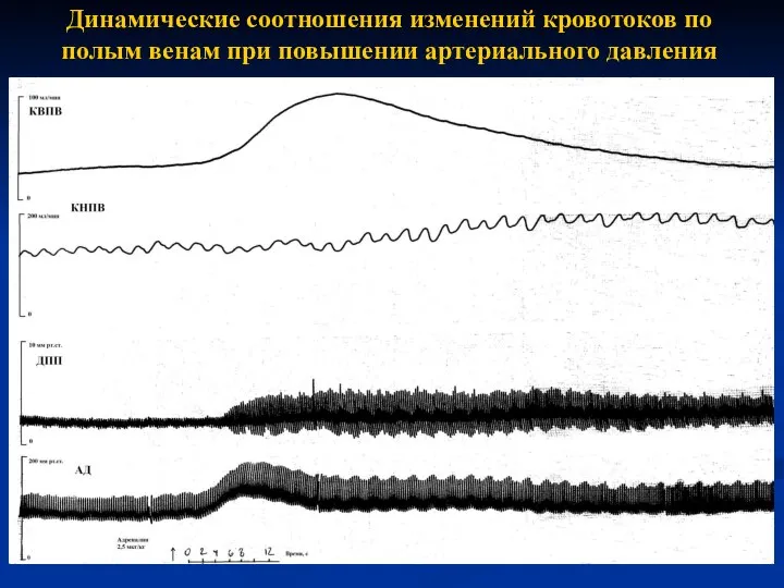 Динамические соотношения изменений кровотоков по полым венам при повышении артериального давления