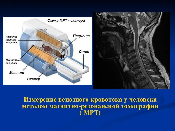 Измерение венозного кровотока у человека методом магнитно-резонансной томографии ( МРТ)