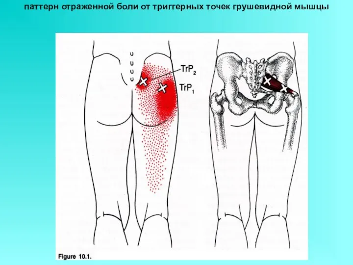 паттерн отраженной боли от триггерных точек грушевидной мышцы