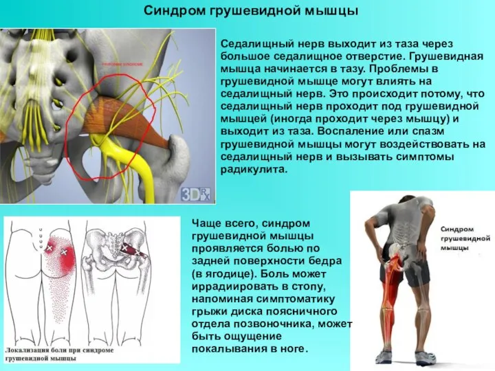 Синдром грушевидной мышцы Чаще всего, синдром грушевидной мышцы проявляется болью по