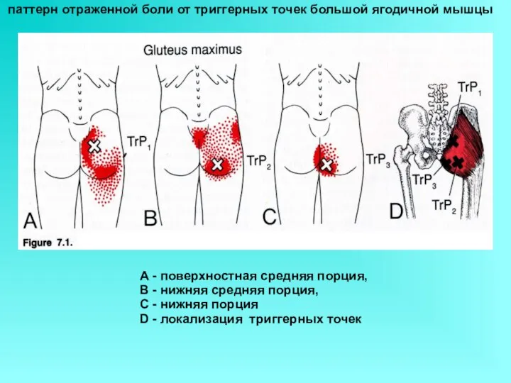 А - поверхностная средняя порция, В - нижняя средняя порция, С