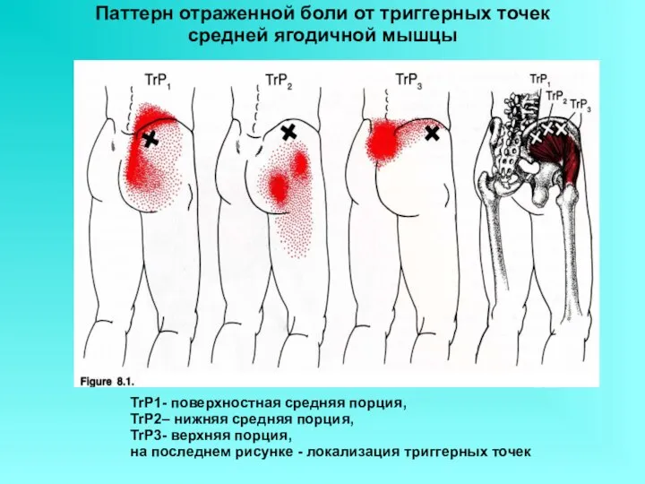 Паттерн отраженной боли от триггерных точек средней ягодичной мышцы TrP1- поверхностная