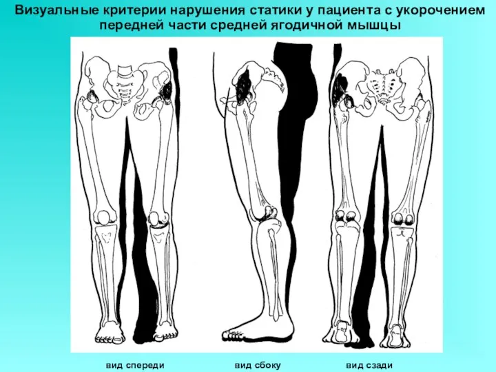 Визуальные критерии нарушения статики у пациента с укорочением передней части средней