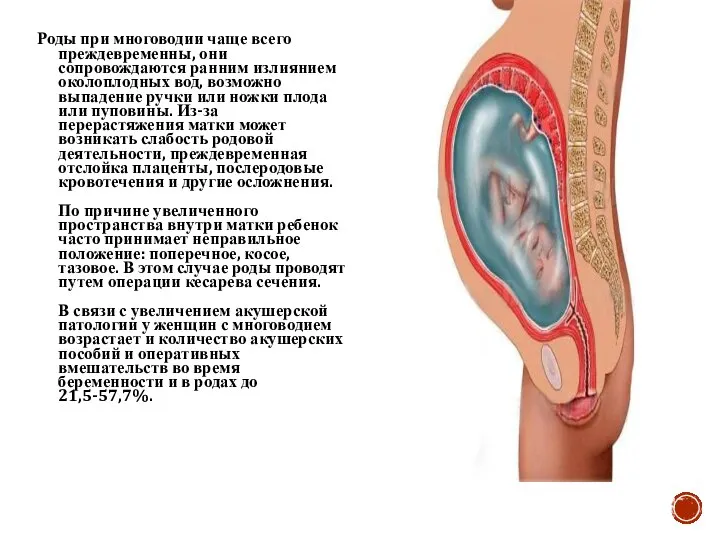 Роды при многоводии чаще всего преждевременны, они сопровождаются ранним излиянием околоплодных