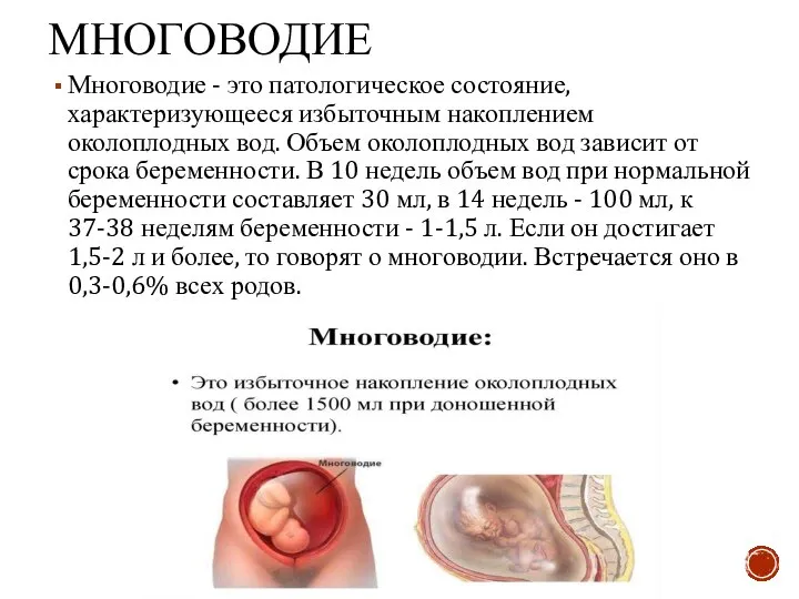 МНОГОВОДИЕ Многоводие - это патологическое состояние, характеризующееся избыточным накоплением околоплодных вод.