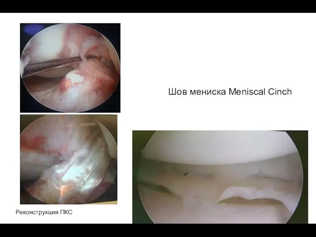 Шов мениска Meniscal Cinch Реконструкция ПКС