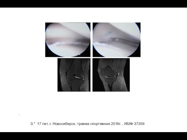 . З.* 17 лет, г. Новосибирск, травма спортивная 2016г. , ИБ№ 37359