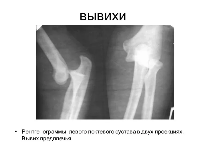 Рентгенограммы левого локтевого сустава в двух проекциях. Вывих предплечья вывихи