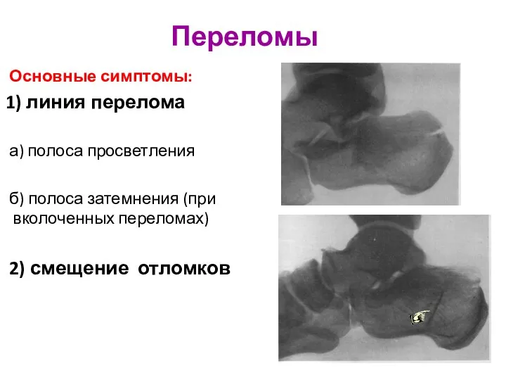 Основные симптомы: 1) линия перелома а) полоса просветления б) полоса затемнения