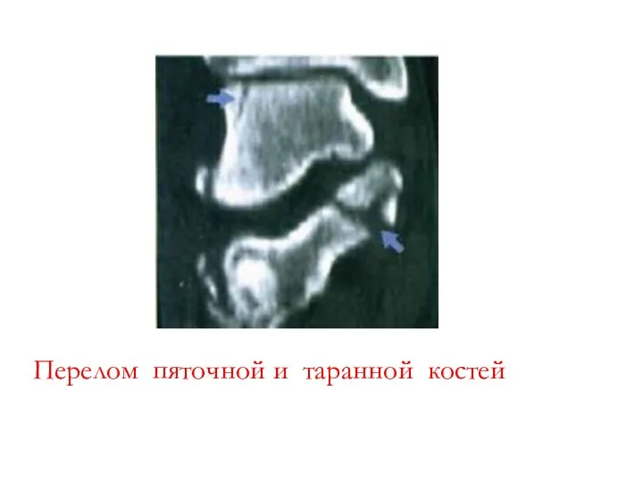 Перелом пяточной и таранной костей