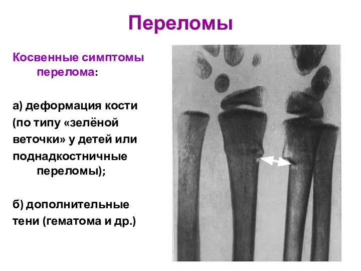 Косвенные симптомы перелома: а) деформация кости (по типу «зелёной веточки» у